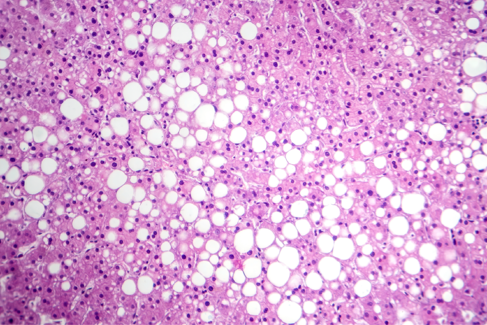 Photomicrograph of hepatic steatosis 