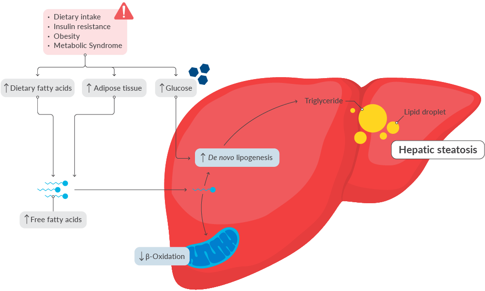 Summary of pathways leading to hepatic lipid accumulation in MASLD