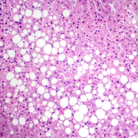 Targeting Metabolic Factors in MASLD & MASH