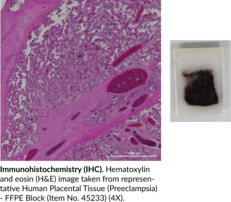 Human Placental Tissue (Preeclampsia) - FFPE Block (Human Placental Tissue (Preeclampsia) - Formalin-Fixed, Paraffin-Embedded Block)