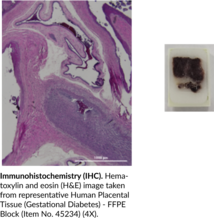 Human Placental Tissue (Gestational Diabetes) - FFPE Block (Human Placental Tissue (Gestational Diabetes) - Formalin-Fixed, Paraffin-Embedded Block)